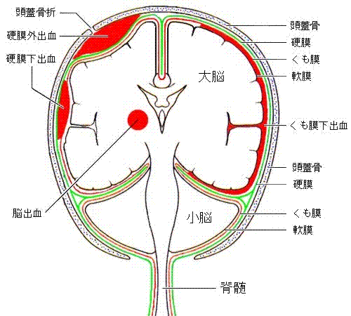 打撲 頭 部